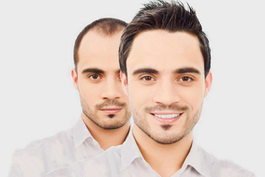 Hair Transplantation Service in Hyderabad